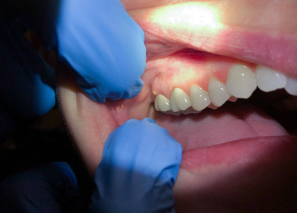 Best Emergency Treatment for Dental Infections or Abscesses in West Fargo, ND